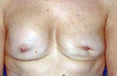Résultat d'une plastie mammaire de réduction