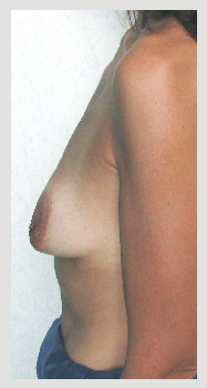 les injections de macrolane dans les seins sont une escroquerie