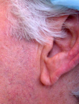 Hypertrophie du lobe d'oreille