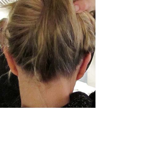 chirurgie-esthetique-pierre-nahon-interventions-oreilles-13