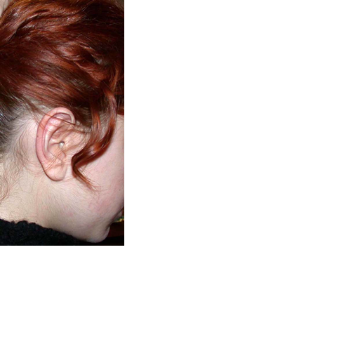 chirurgie-esthetique-pierre-nahon-interventions-oreilles-03