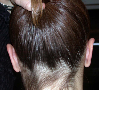 chirurgie-esthetique-pierre-nahon-interventions-oreilles-05