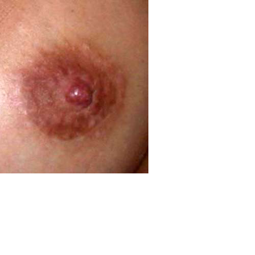 chirurgie-esthetique-interventions-seins-reduction-mamelon-01