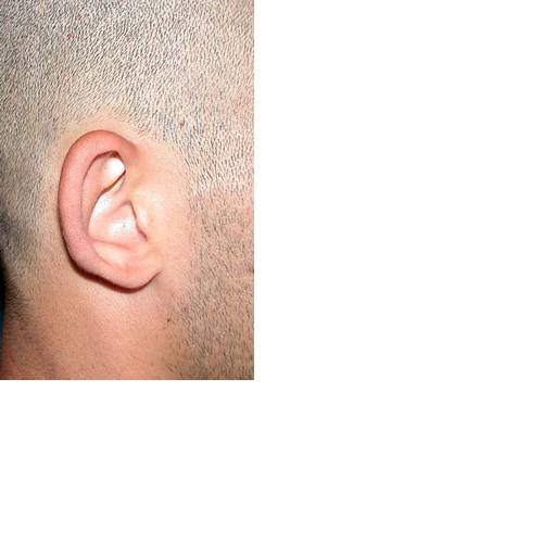 chirurgie-esthetique-pierre-nahon-interventions-oreilles-10