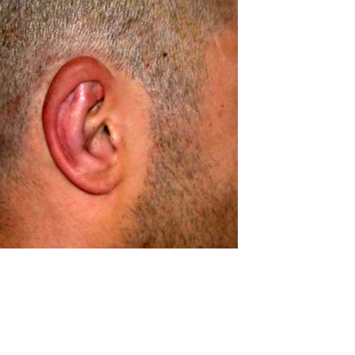 chirurgie-esthetique-pierre-nahon-interventions-oreilles-11