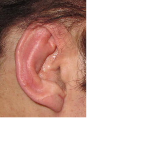 réduction d'oreilles