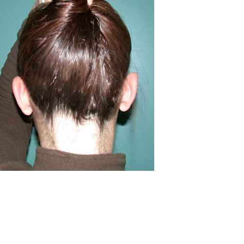 chirurgie-esthetique-pierre-nahon-interventions-oreilles-04