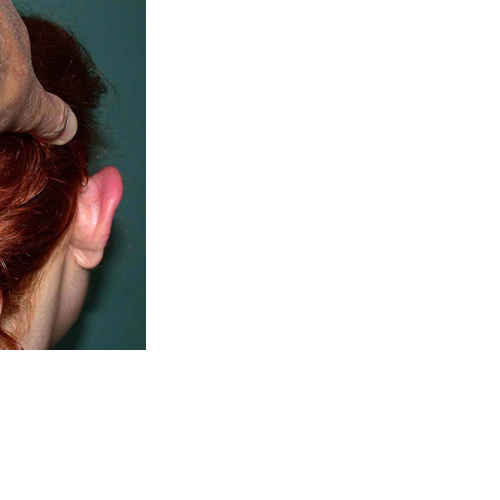 chirurgie-esthetique-pierre-nahon-interventions-oreilles-06