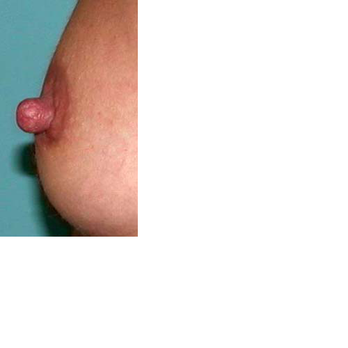 chirurgie-esthetique-interventions-seins-reduction-mamelon