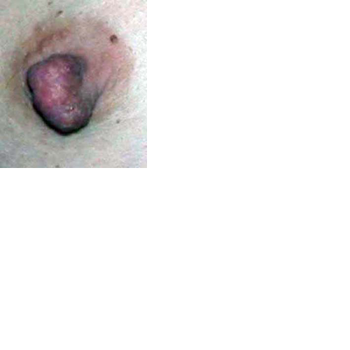 chirurgie-esthetique-interventions-seins-reduction-mamelon