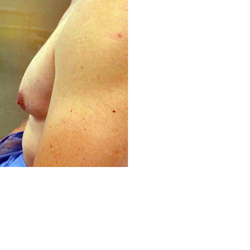 chirurgie-esthetique-interventions-gynecomasties