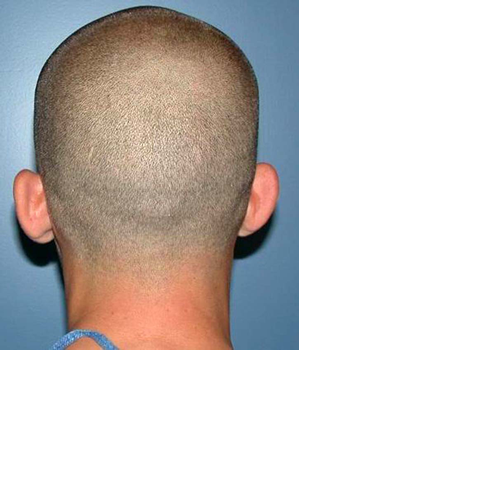 chirurgie-esthetique-pierre-nahon-interventions-oreilles-08
