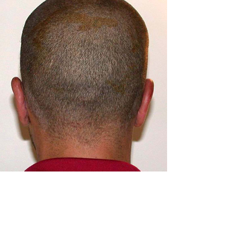 chirurgie-esthetique-pierre-nahon-interventions-oreilles-09