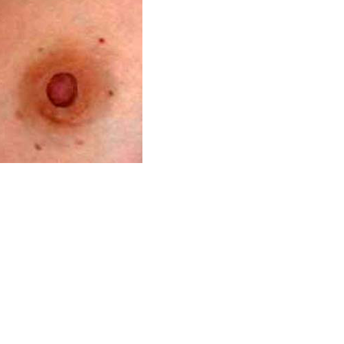 chirurgie-esthetique-interventions-seins-reduction-mamelon