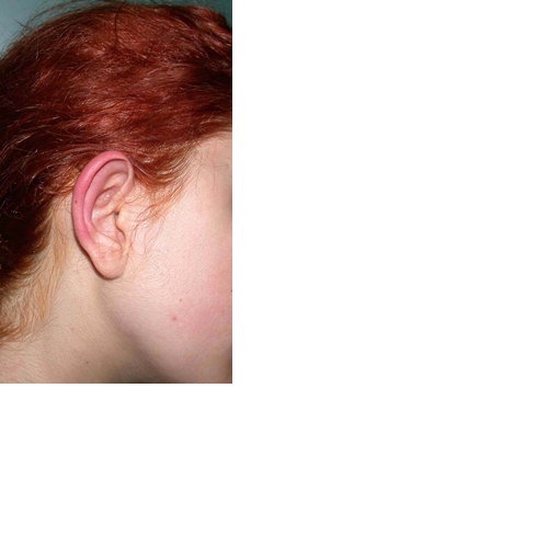 chirurgie-esthetique-pierre-nahon-interventions-oreilles-02