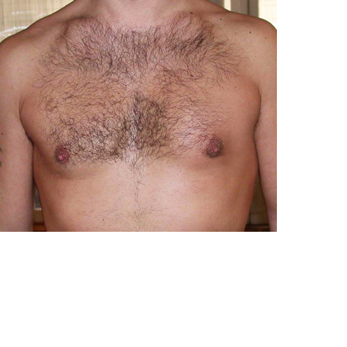 chirurgie-esthetique-interventions-gynecomasties