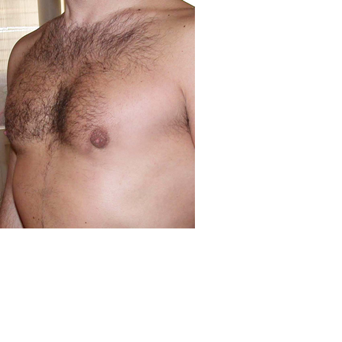 chirurgie-esthetique-interventions-gynecomasties