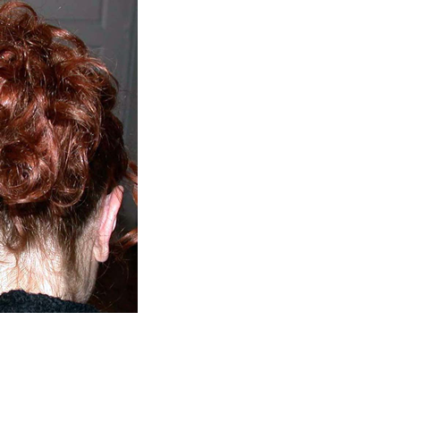 chirurgie-esthetique-pierre-nahon-interventions-oreilles-07