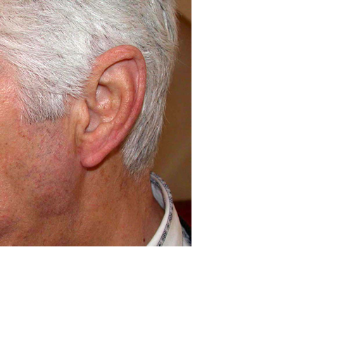 chirurgie-esthetique-pierre-nahon-interventions-oreilles-01