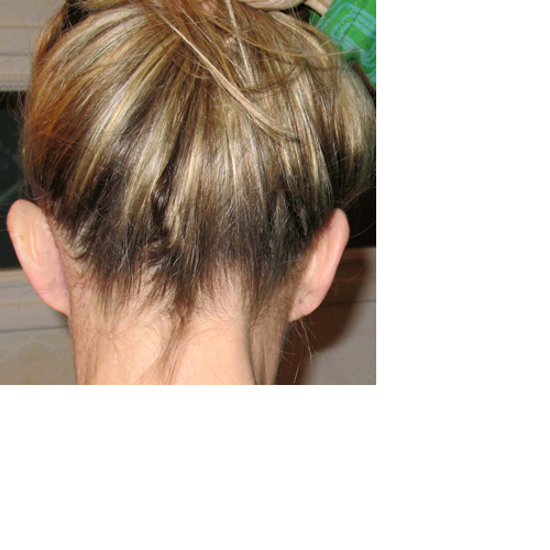 chirurgie-esthetique-pierre-nahon-interventions-oreilles-12